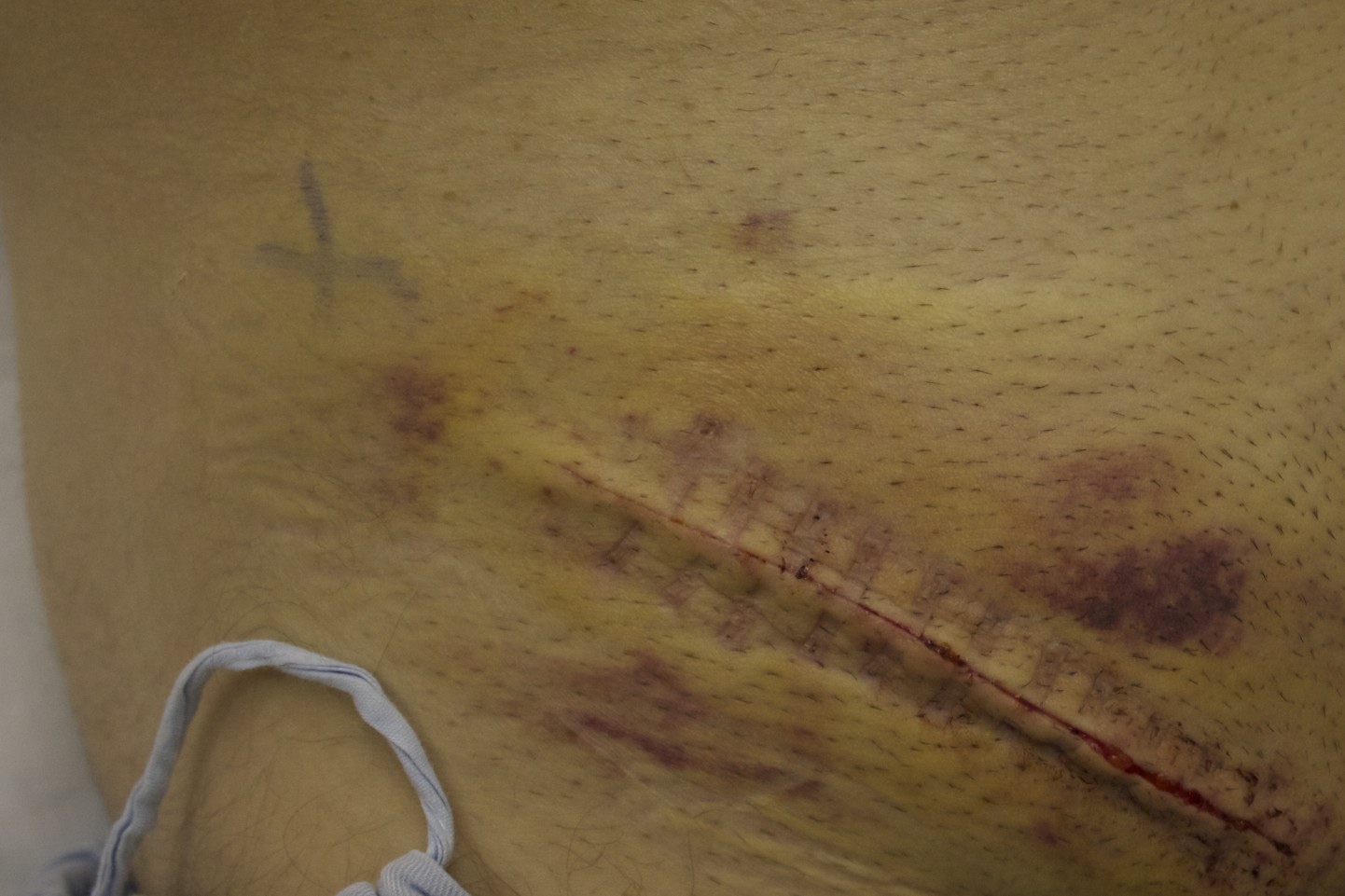 Why would you have blood mixed with urine from a catheter after hernia surgery?
